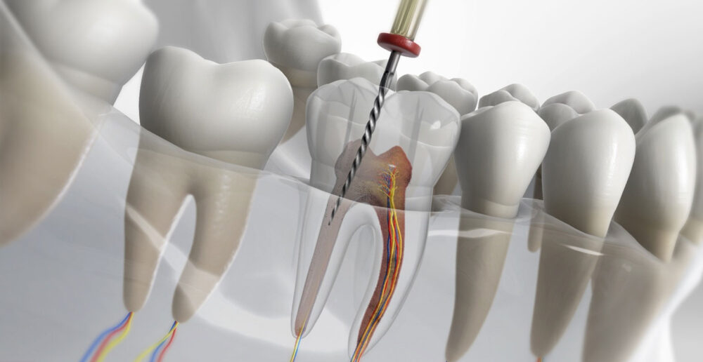 Ποιες είναι οι συνήθεις ενδοδοντικές θεραπείες;