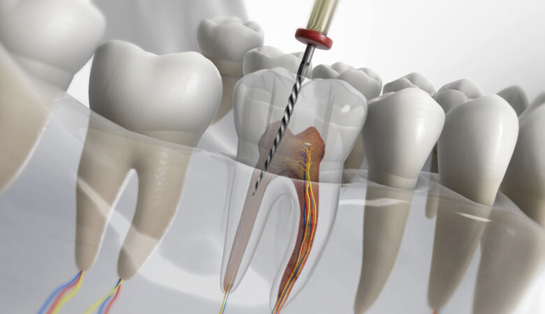 Ποιες είναι οι συνήθεις ενδοδοντικές θεραπείες;